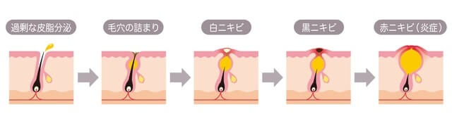 皮脂の過剰分泌を調節する